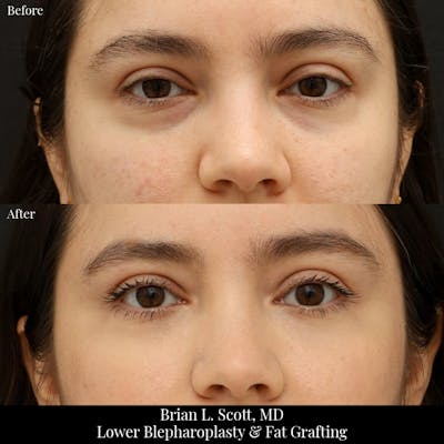 Facial Fat Transfer Before & After Gallery - Patient 352624 - Image 1