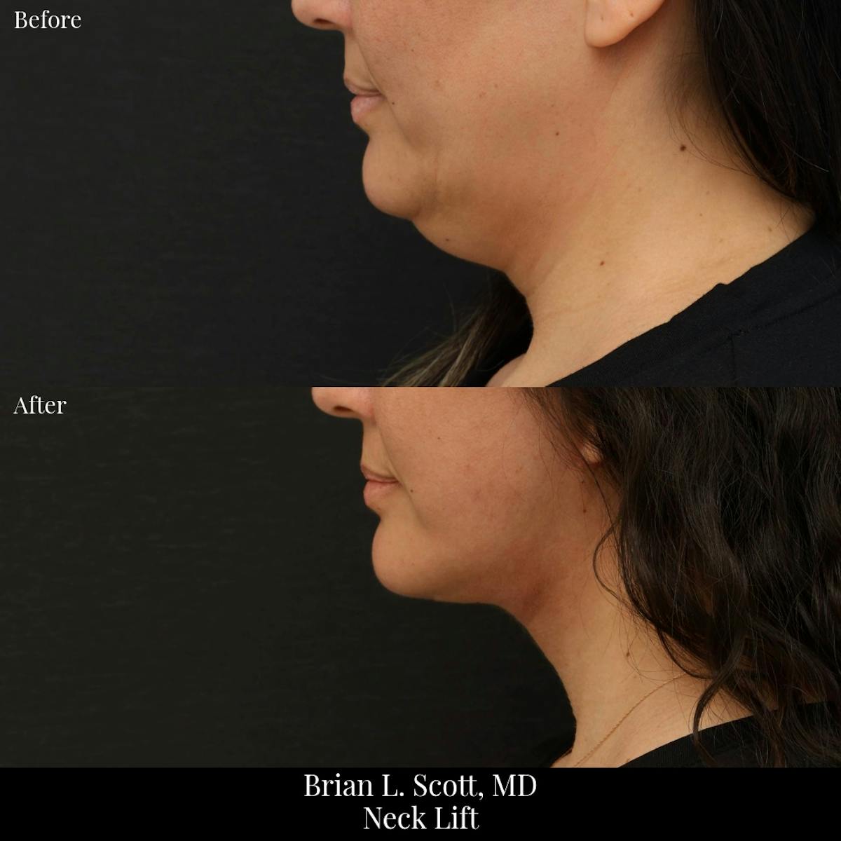 Neck Lift Before & After Gallery - Patient 216815 - Image 2