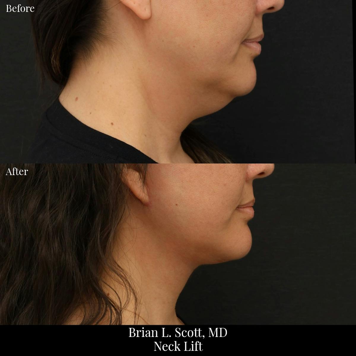 Neck Lift Before & After Gallery - Patient 216815 - Image 1