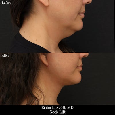 Neck Lift Before & After Gallery - Patient 216815 - Image 1