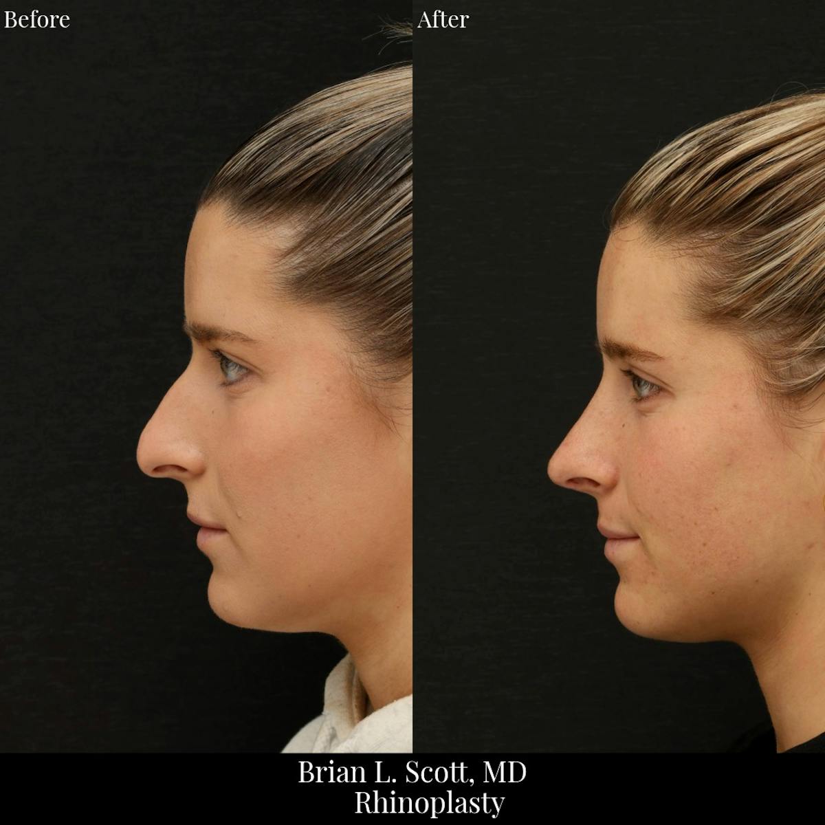 Rhinoplasty Before & After Gallery - Patient 221182 - Image 1