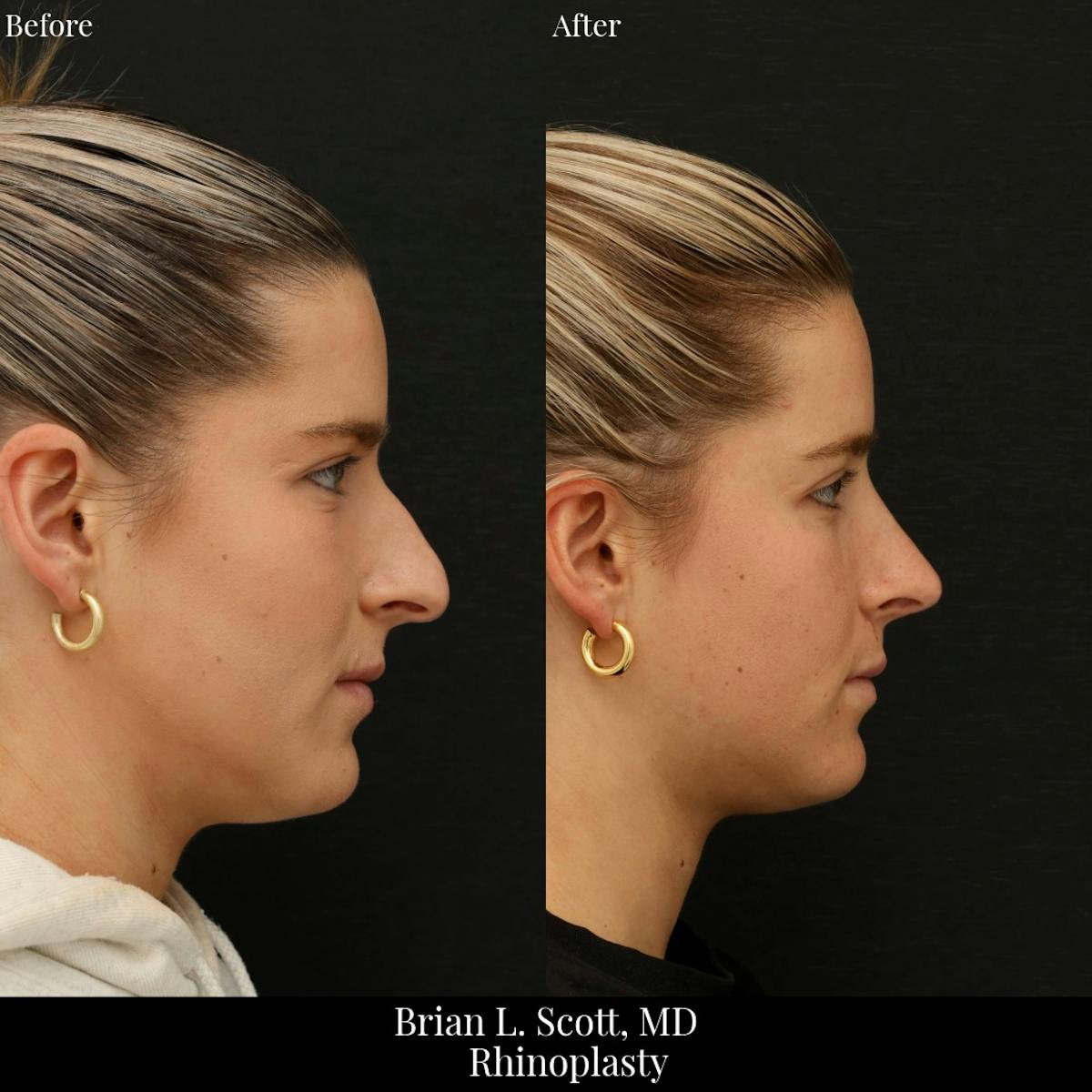 Rhinoplasty Before & After Gallery - Patient 221182 - Image 2