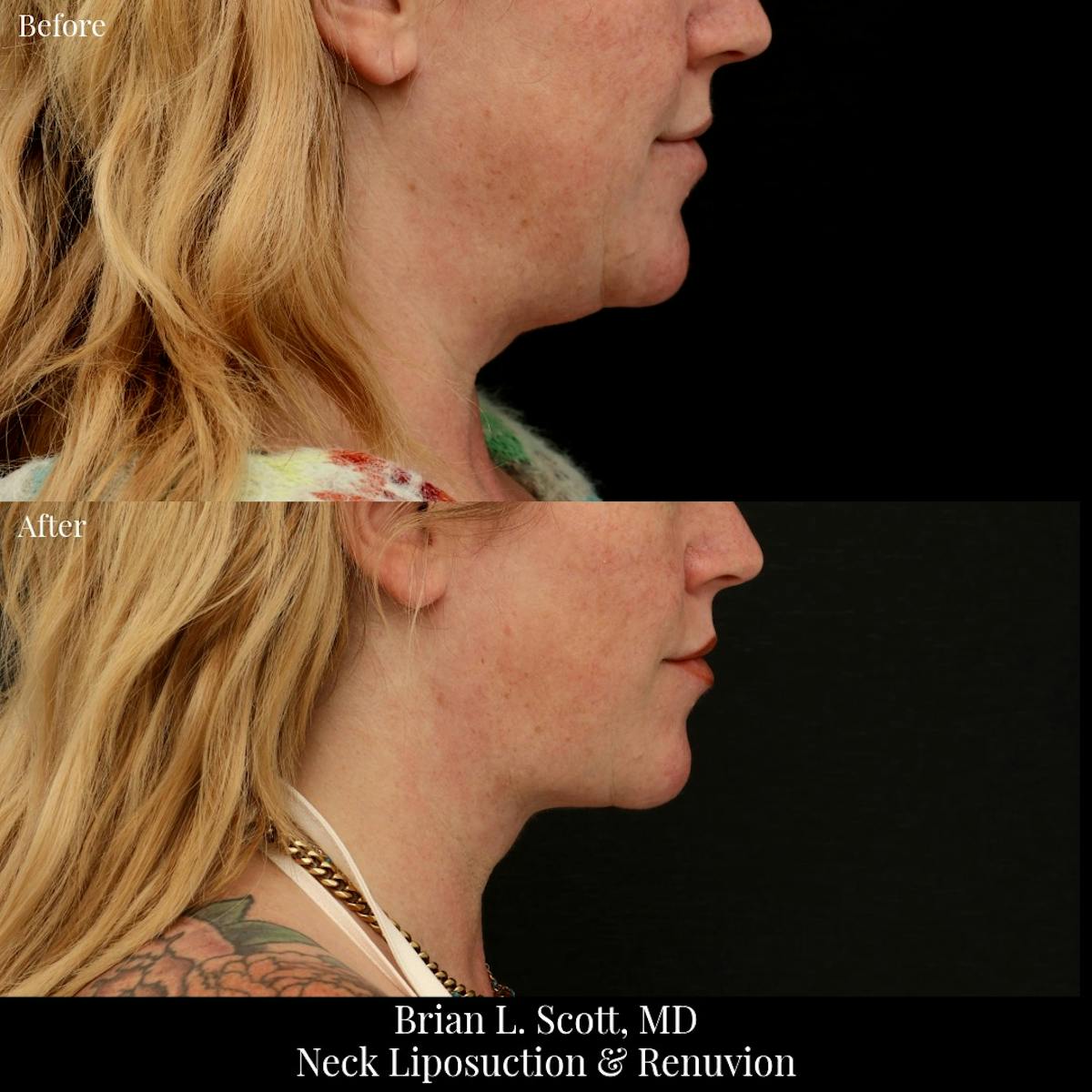 Neck Liposuction Before & After Gallery - Patient 381257 - Image 1