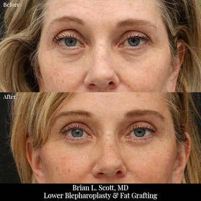 Lower Blepharoplasty Before & After Gallery - Patient 318898 - Image 1