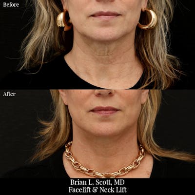 Neck Lift Before & After Gallery - Patient 256545 - Image 1