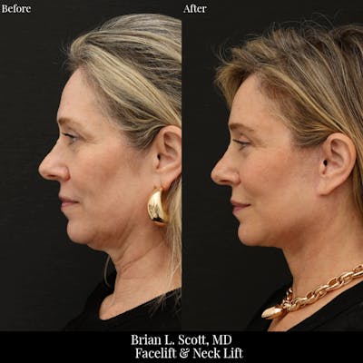 Facelift Before & After Gallery - Patient 317215 - Image 1
