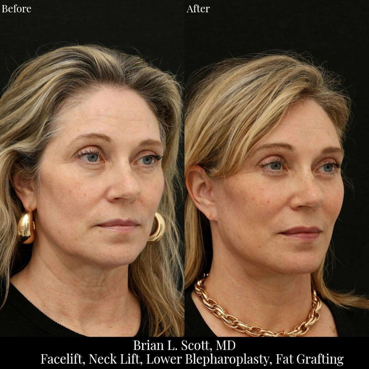 Facelift Before & After Gallery - Patient 317215 - Image 3