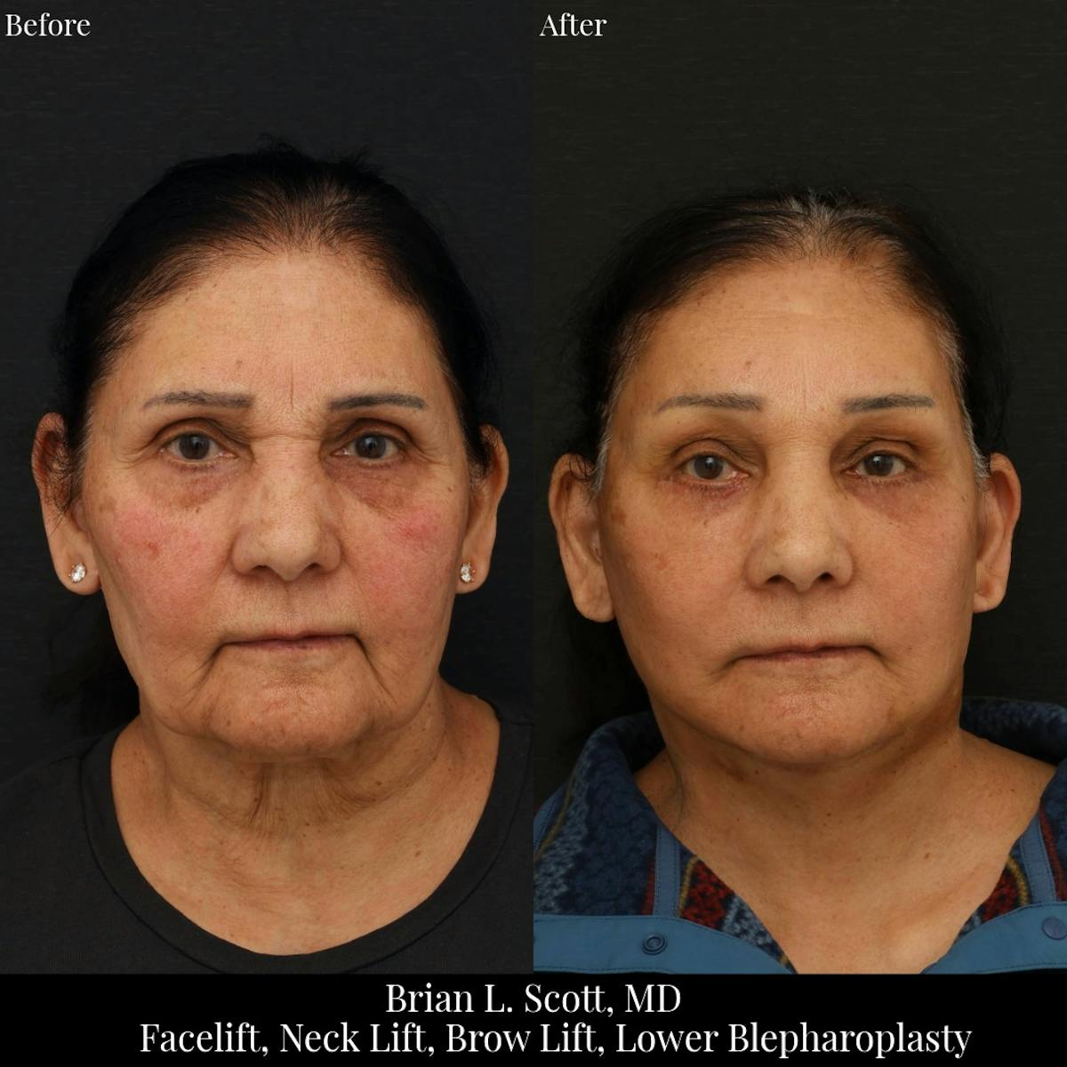 Facelift Before & After Gallery - Patient 108739 - Image 2