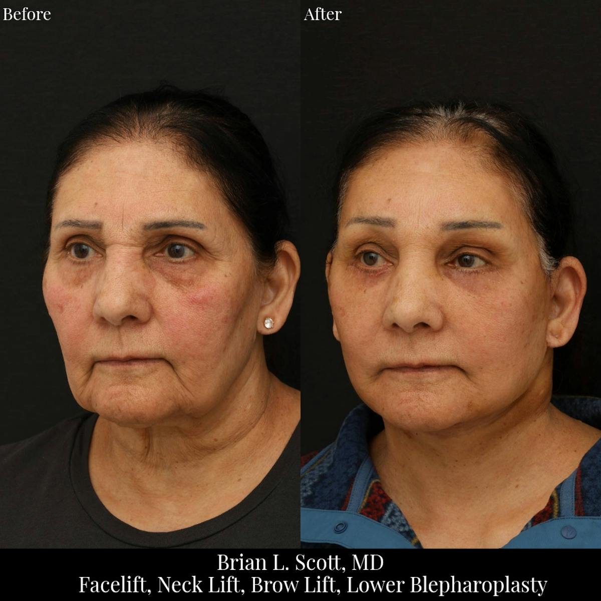Facelift Before & After Gallery - Patient 108739 - Image 1