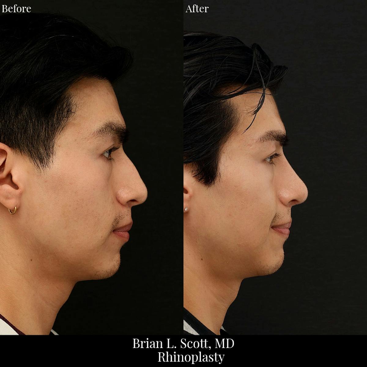 Rhinoplasty Before & After Gallery - Patient 128506 - Image 1