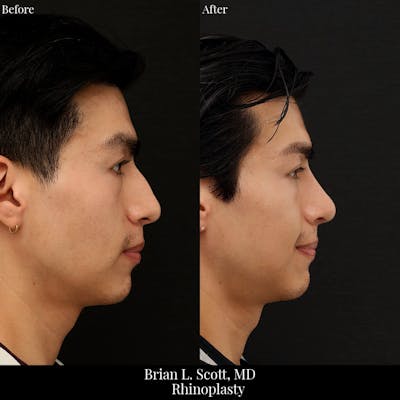 Rhinoplasty Before & After Gallery - Patient 128506 - Image 1