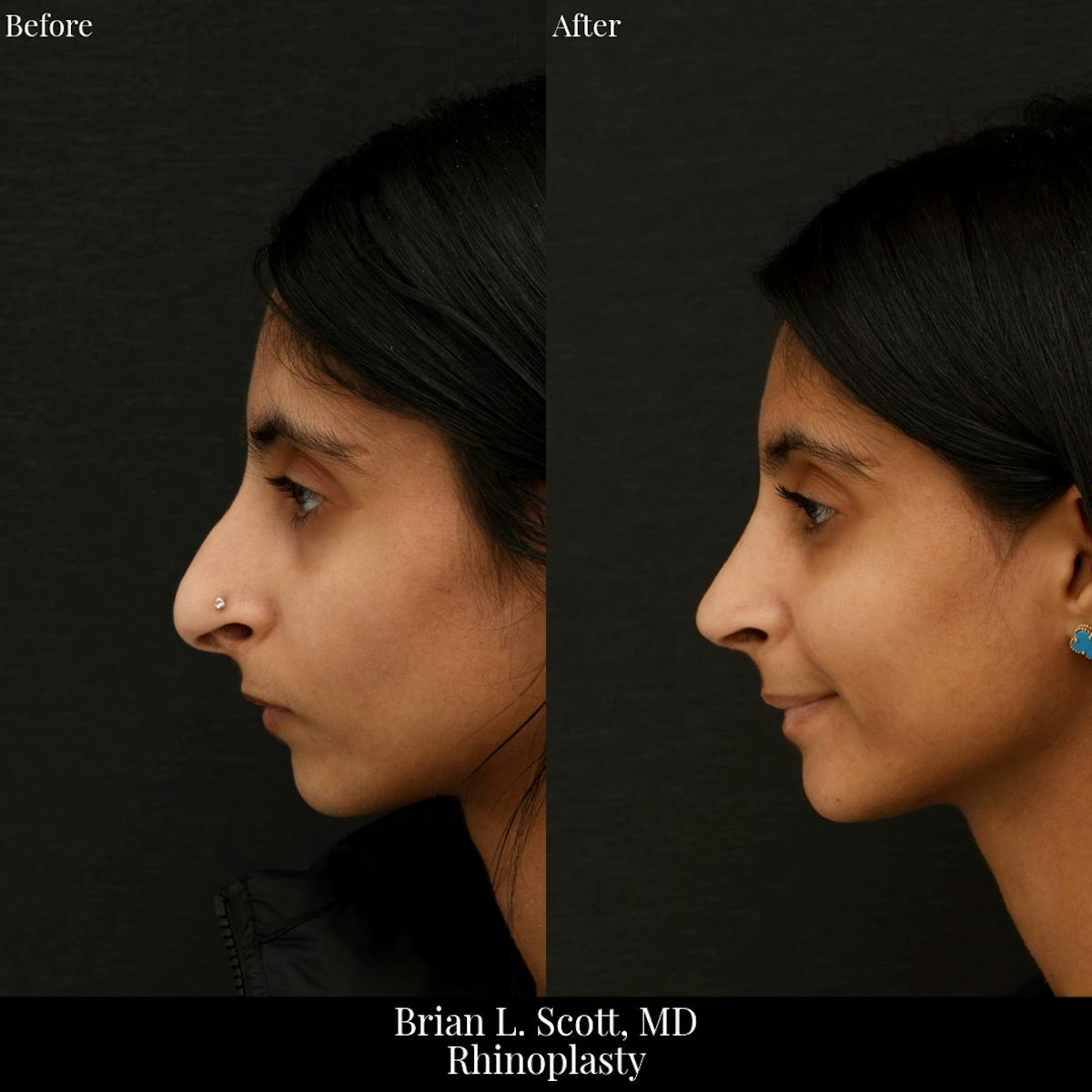 Rhinoplasty Before & After Gallery - Patient 400377 - Image 1