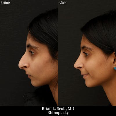 Rhinoplasty Before & After Gallery - Patient 400377 - Image 1