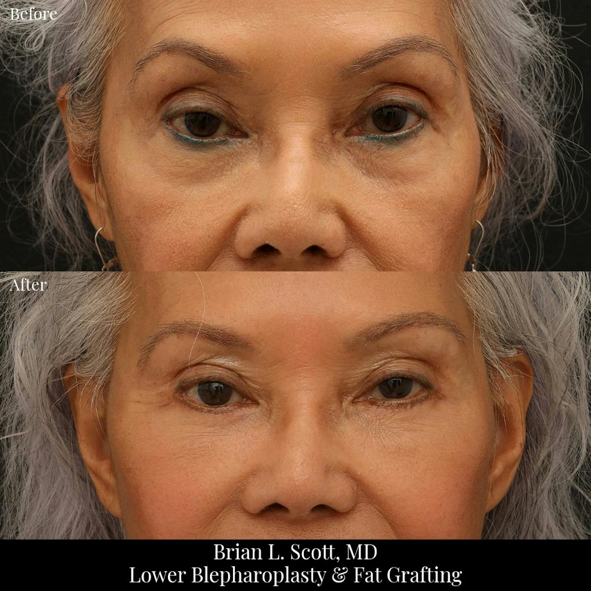 Facial Fat Transfer Before & After Gallery - Patient 416228 - Image 1