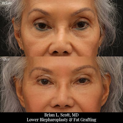 Lower Blepharoplasty Before & After Gallery - Patient 328122 - Image 1