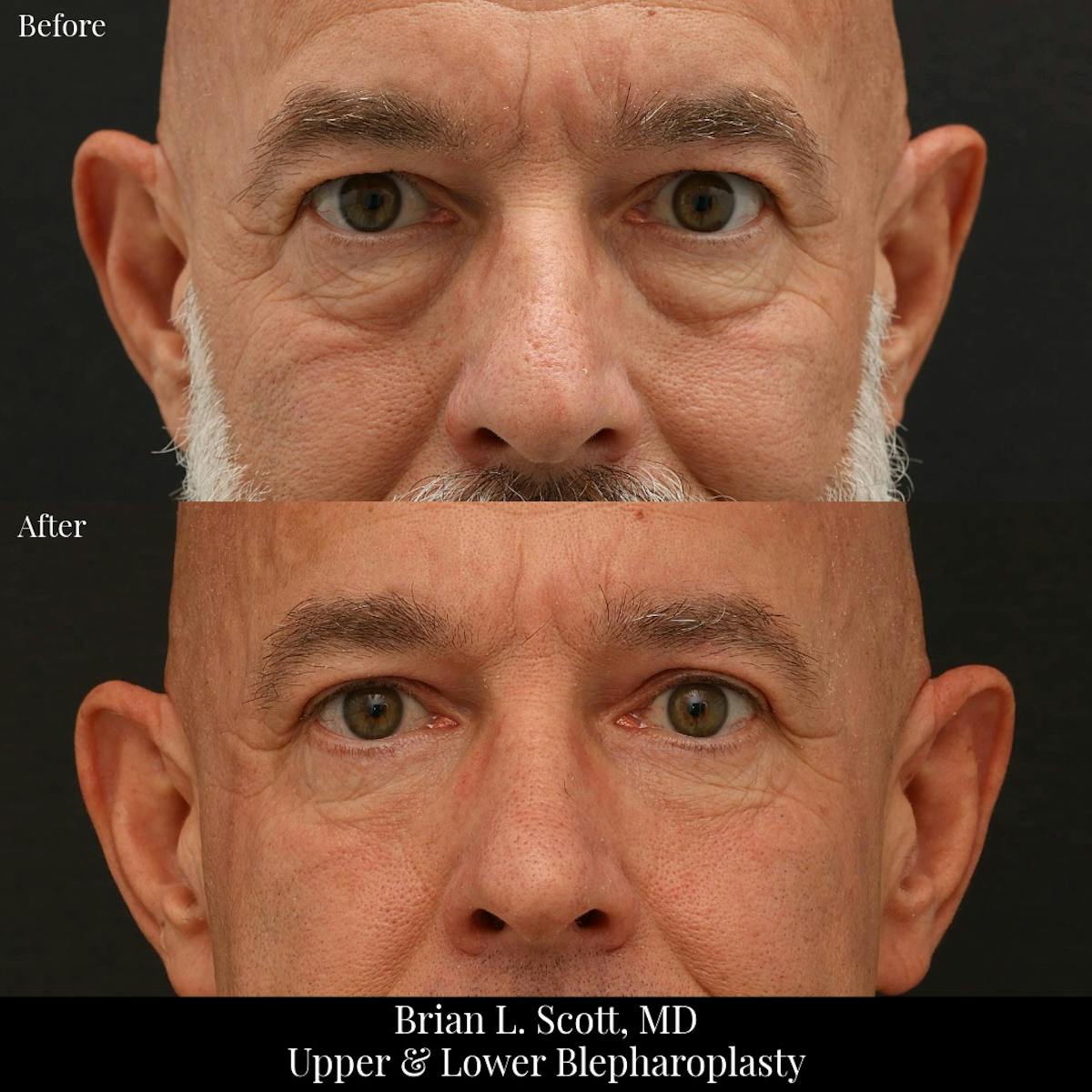Lower Blepharoplasty Before & After Gallery - Patient 161669 - Image 1