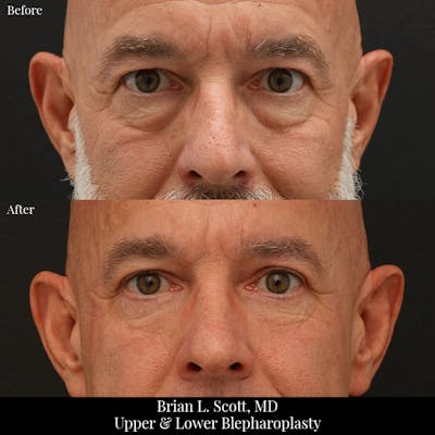 Lower Blepharoplasty Before & After Gallery - Patient 161669 - Image 1