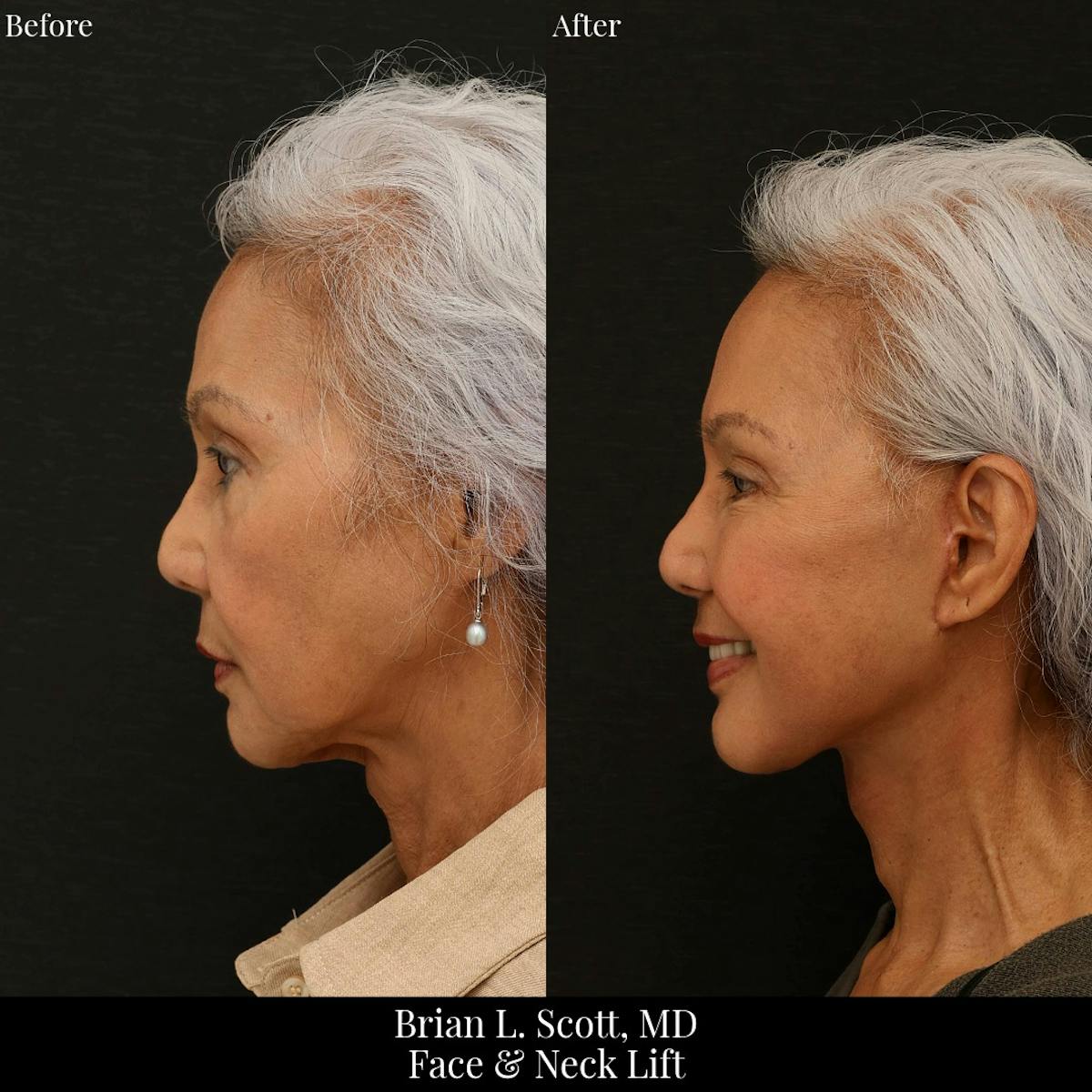 Facelift Before & After Gallery - Patient 384315 - Image 3