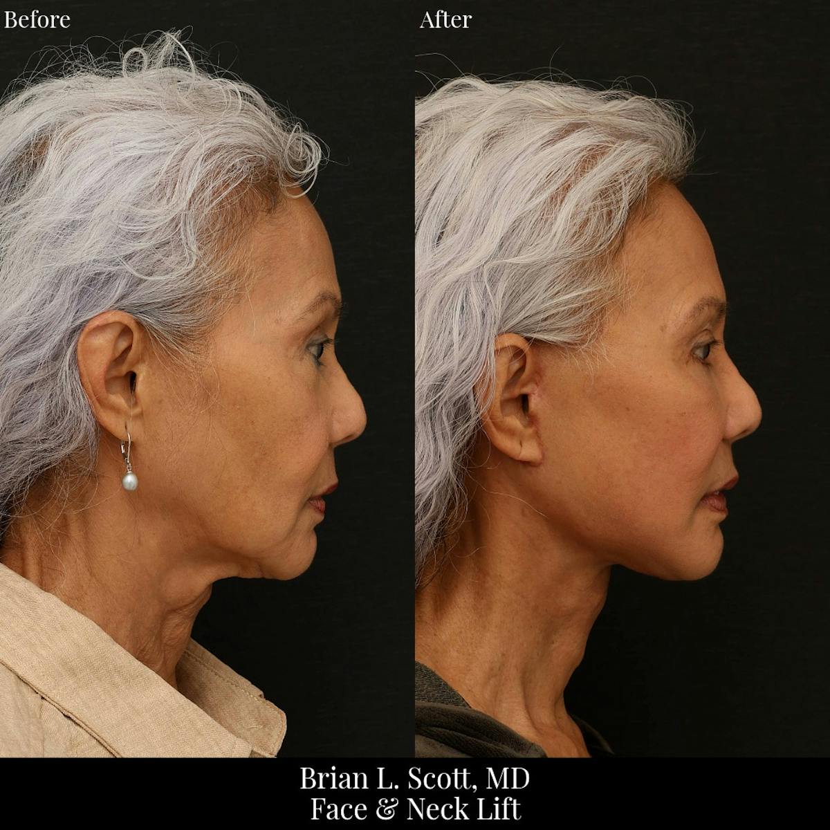Facelift Before & After Gallery - Patient 384315 - Image 2