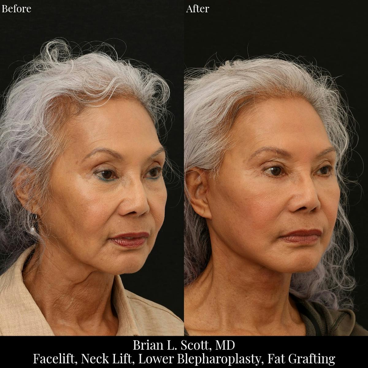 Facelift Before & After Gallery - Patient 384315 - Image 1
