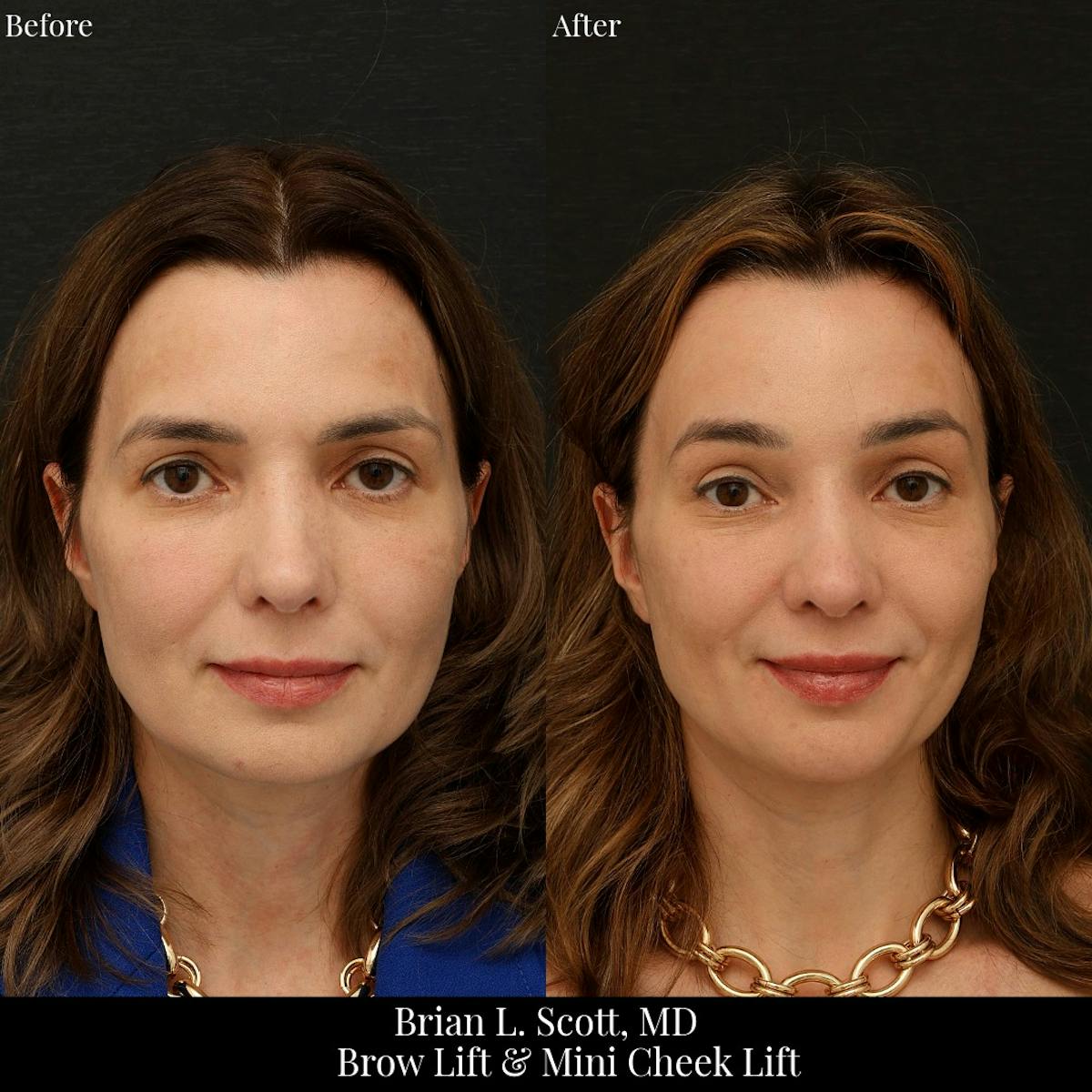 Brow Lift Before & After Gallery - Patient 885569 - Image 1
