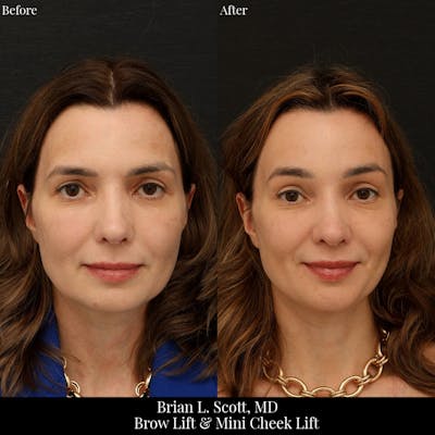 Brow Lift Before & After Gallery - Patient 885569 - Image 1