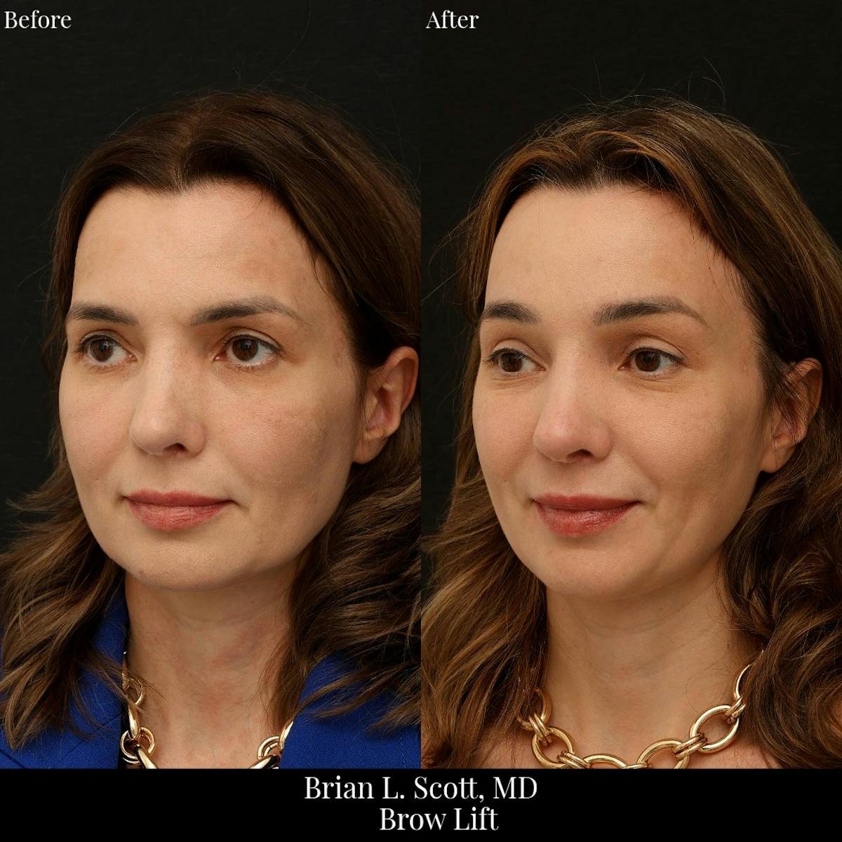 Brow Lift Before & After Gallery - Patient 885569 - Image 2
