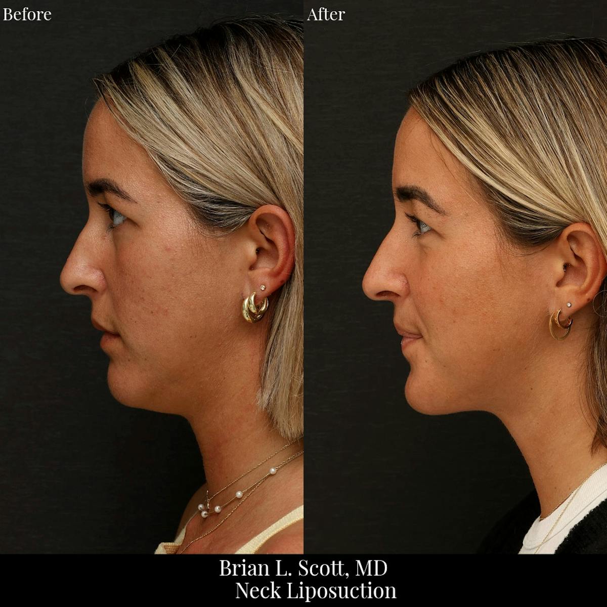 Neck Liposuction Before & After Gallery - Patient 565115 - Image 2