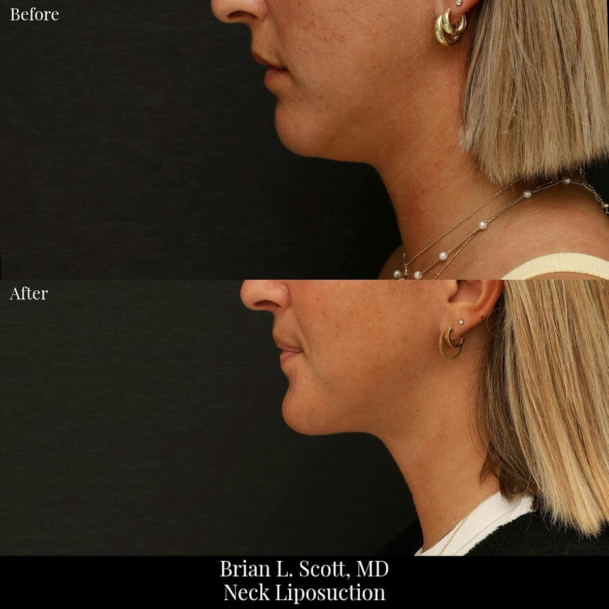 Neck Liposuction Before & After Gallery - Patient 565115 - Image 1