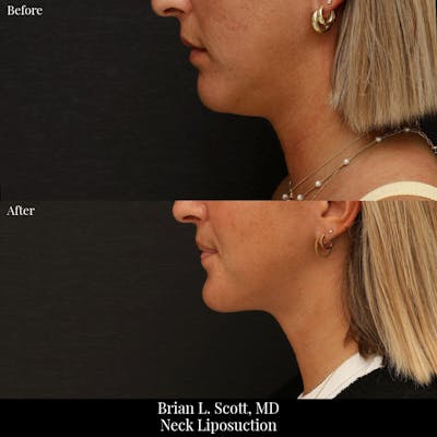 Neck Liposuction Before & After Gallery - Patient 565115 - Image 1