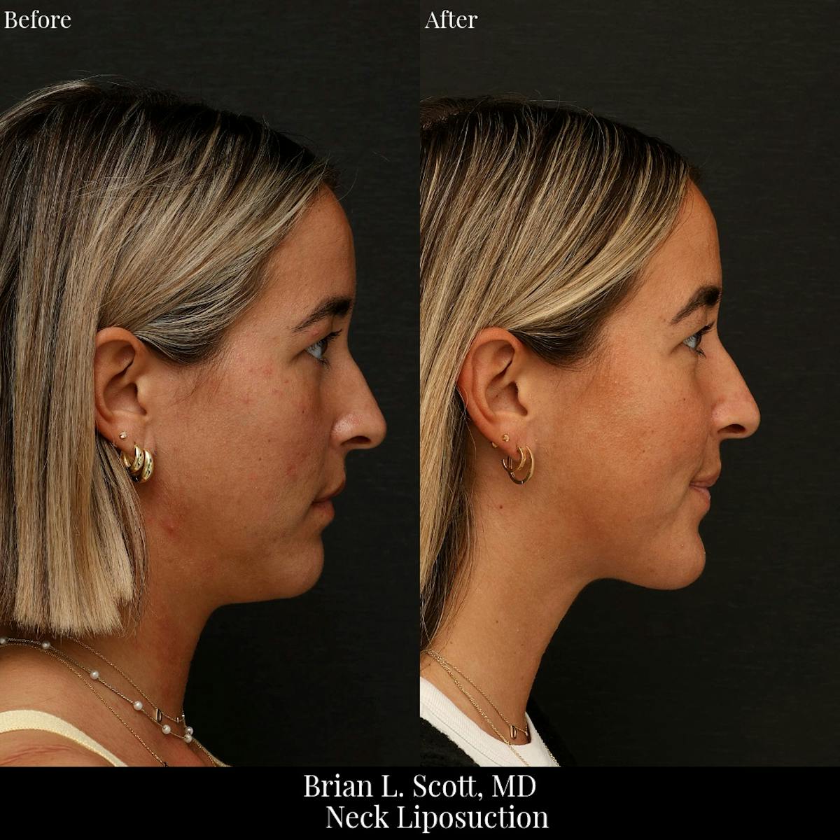 Neck Liposuction Before & After Gallery - Patient 565115 - Image 3
