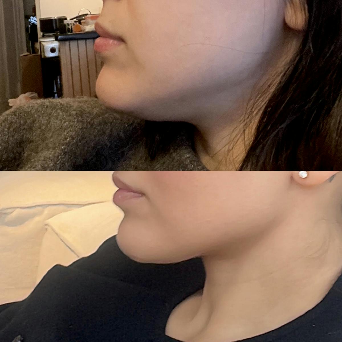 Neck Liposuction Before & After Gallery - Patient 342139 - Image 1