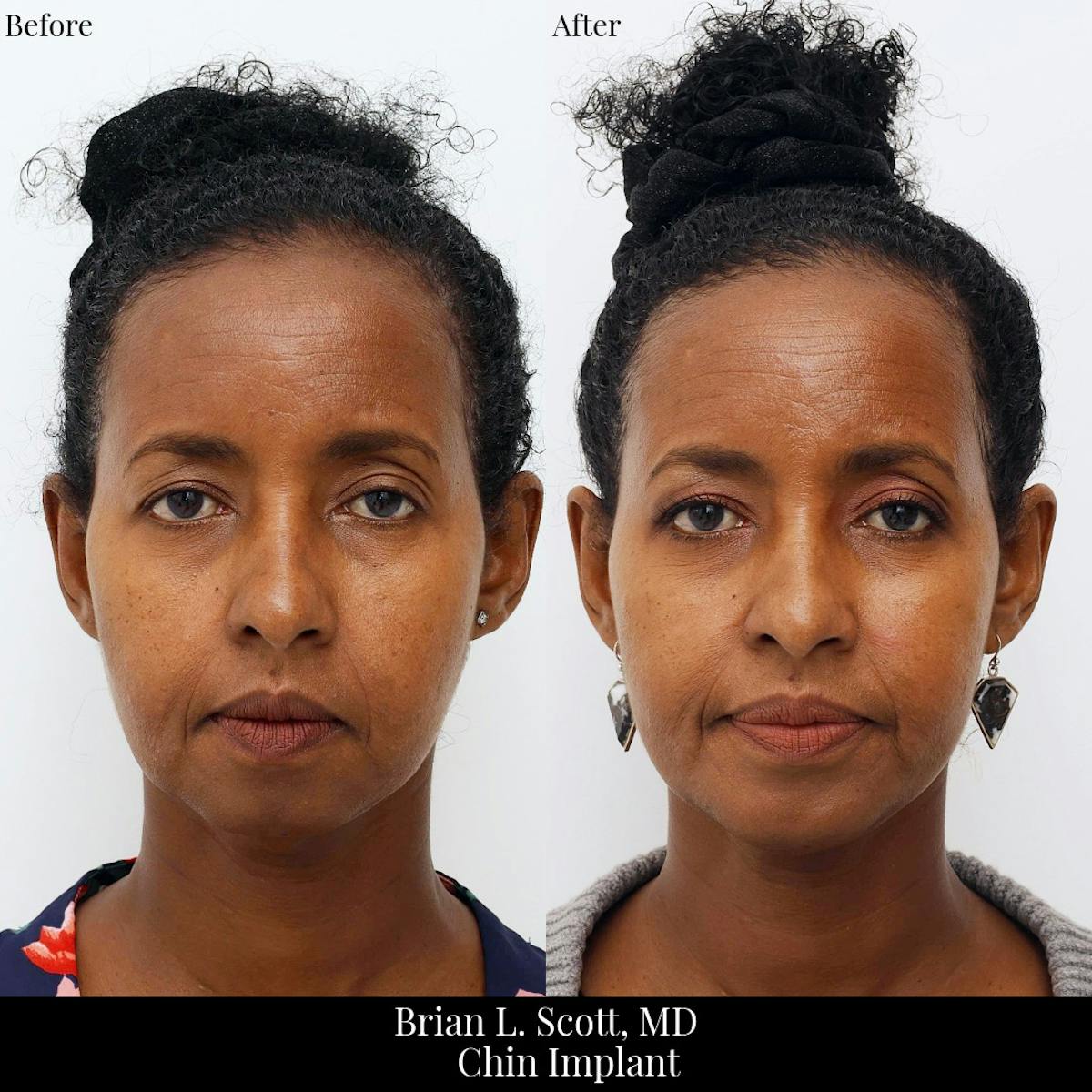 Chin Augmentation Before & After Gallery - Patient 317500 - Image 2