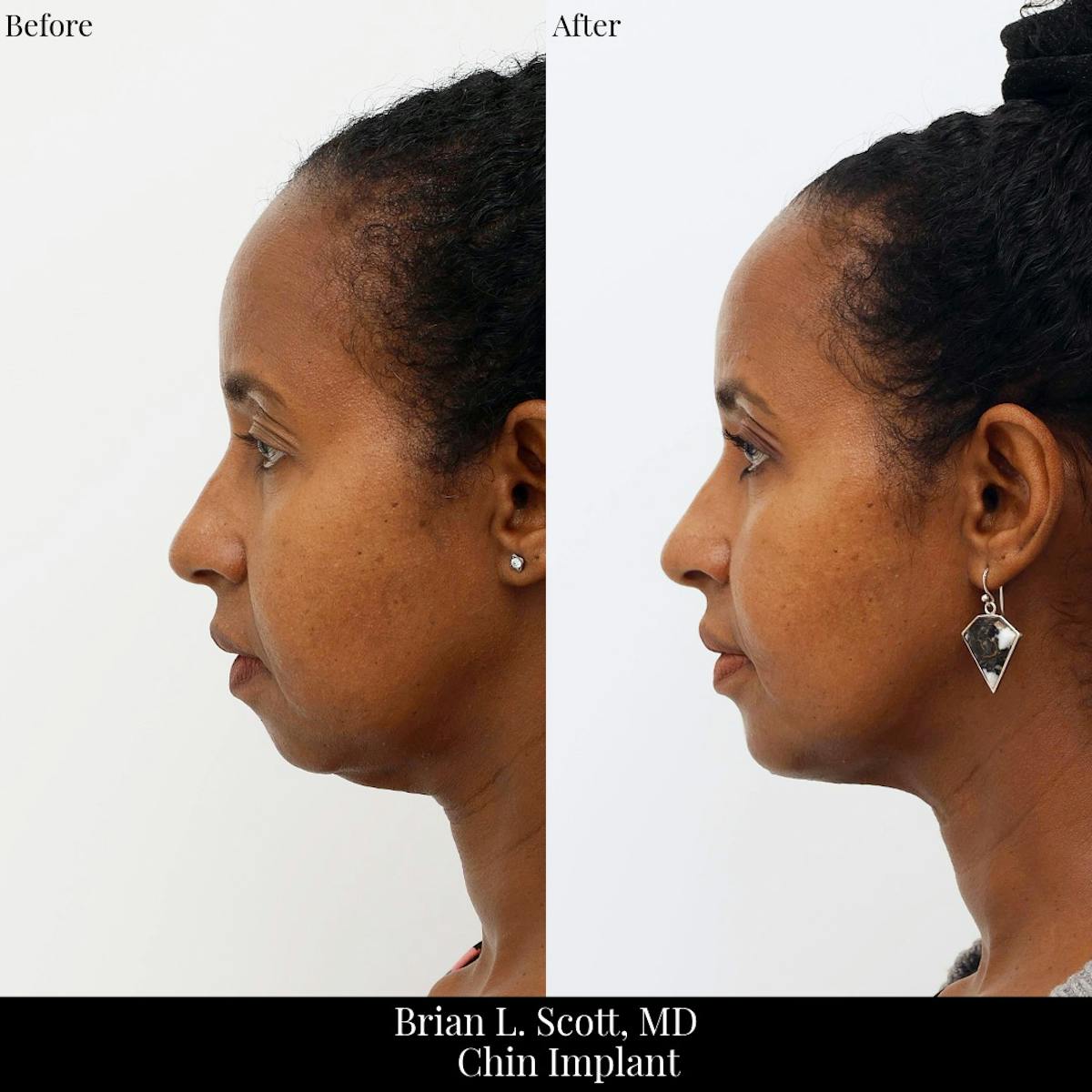 Chin Augmentation Before & After Gallery - Patient 317500 - Image 3