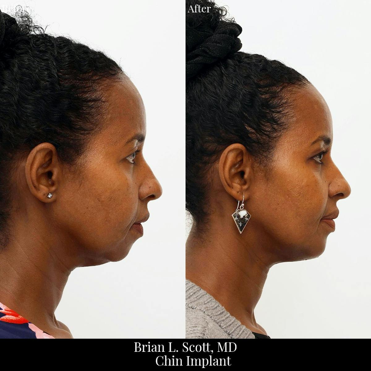 Chin Augmentation Before & After Gallery - Patient 317500 - Image 1