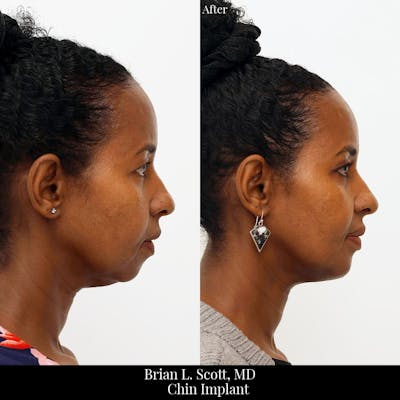 Chin Augmentation Before & After Gallery - Patient 317500 - Image 1
