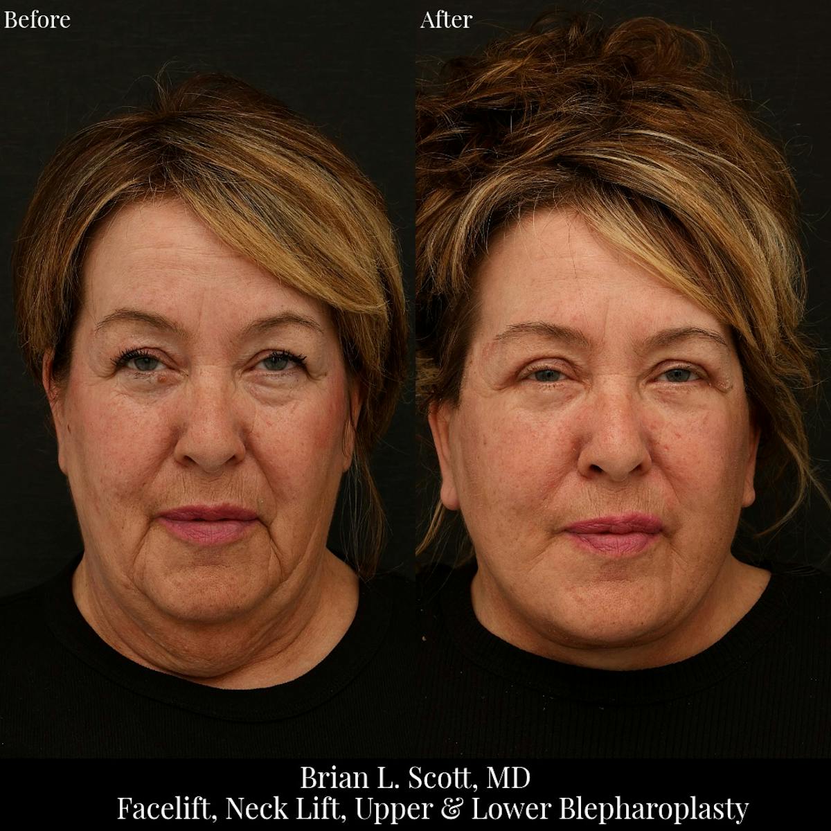 Facelift Before & After Gallery - Patient 260023 - Image 1