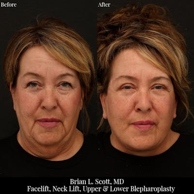 Facelift Before & After Gallery - Patient 260023 - Image 1