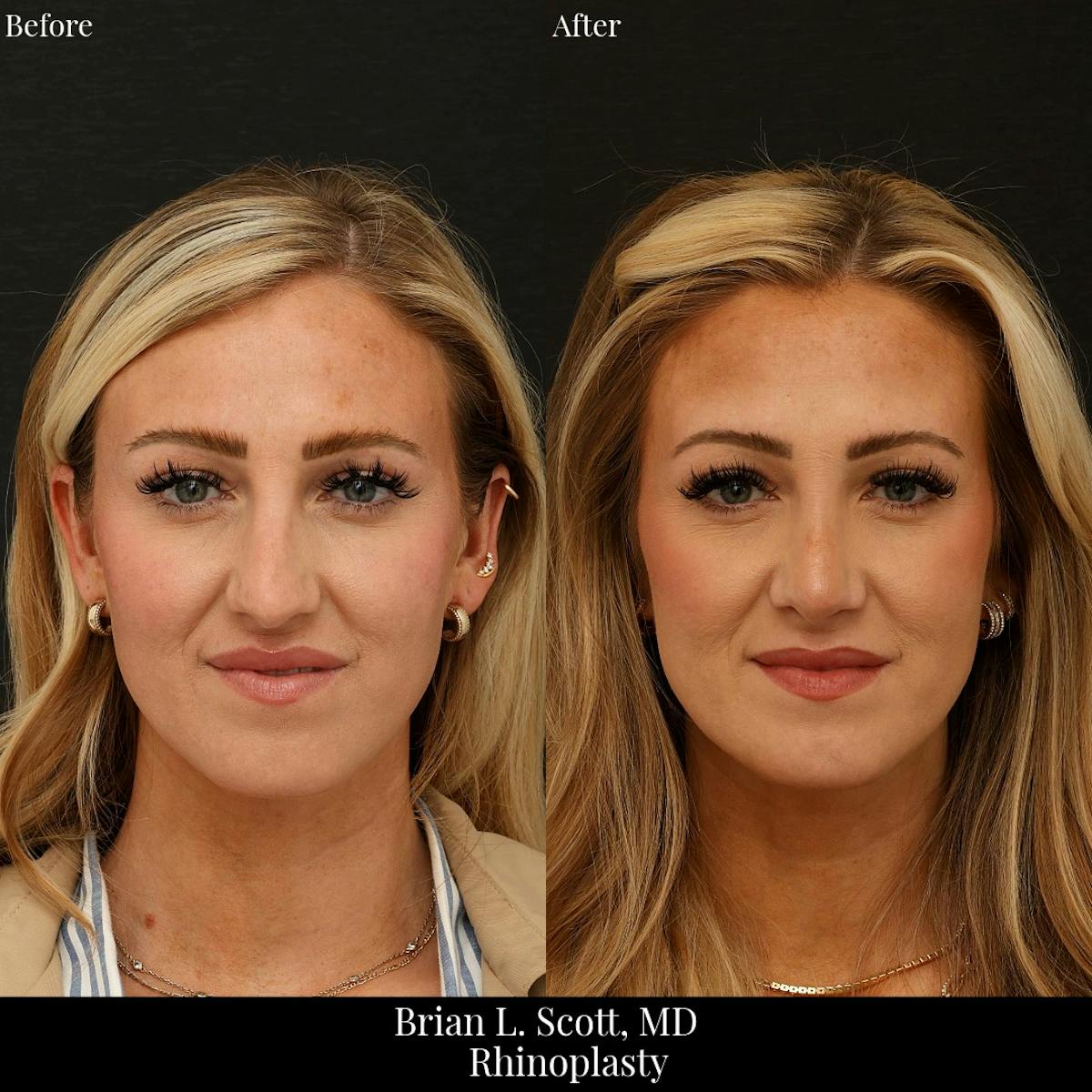 Rhinoplasty Before & After Gallery - Patient 136057 - Image 1