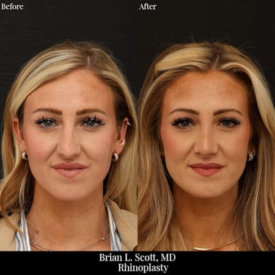 Rhinoplasty Before & After Gallery - Patient 136057 - Image 1