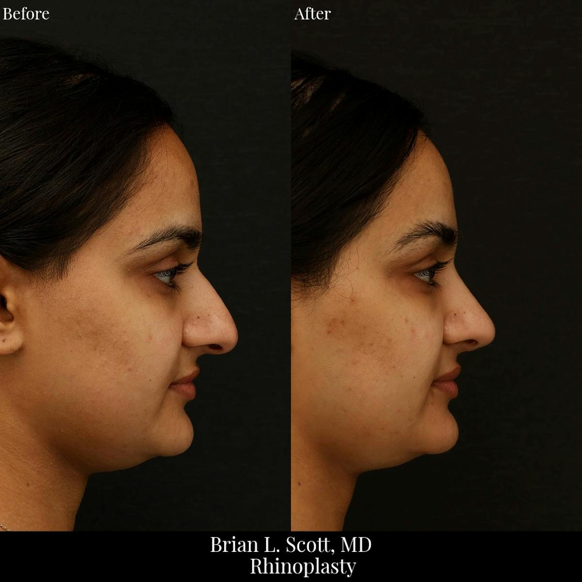 Rhinoplasty Before & After Gallery - Patient 512034 - Image 1