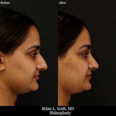 Rhinoplasty Before & After Gallery - Patient 512034 - Image 1