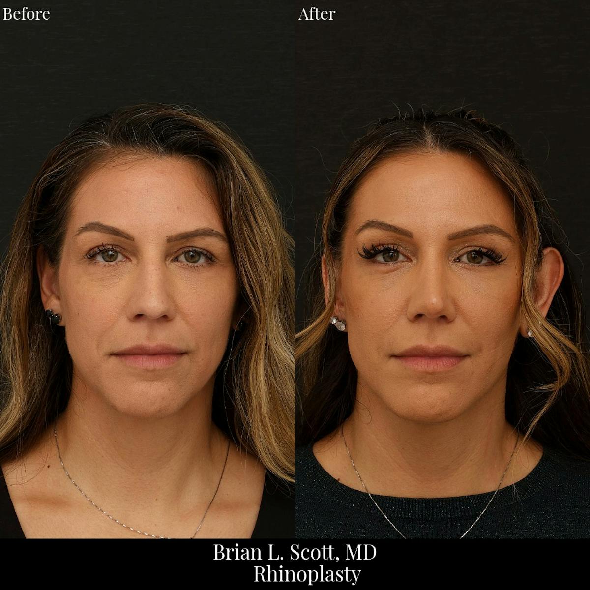 Rhinoplasty Before & After Gallery - Patient 409384 - Image 2