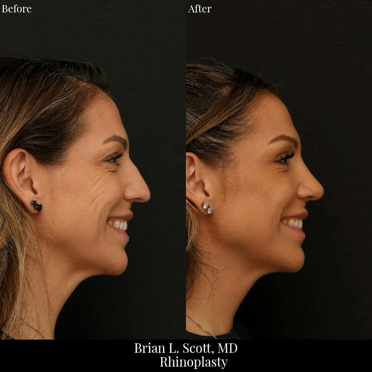 Rhinoplasty Before & After Gallery - Patient 409384 - Image 3