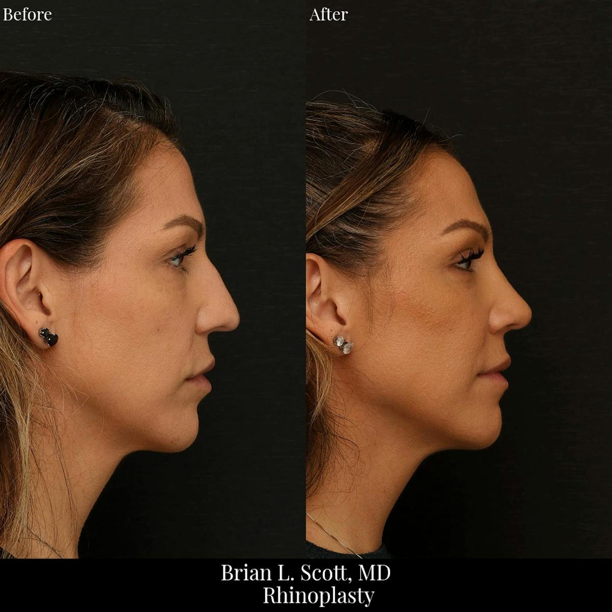 Rhinoplasty Before & After Gallery - Patient 409384 - Image 1
