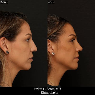 Rhinoplasty Before & After Gallery - Patient 409384 - Image 1
