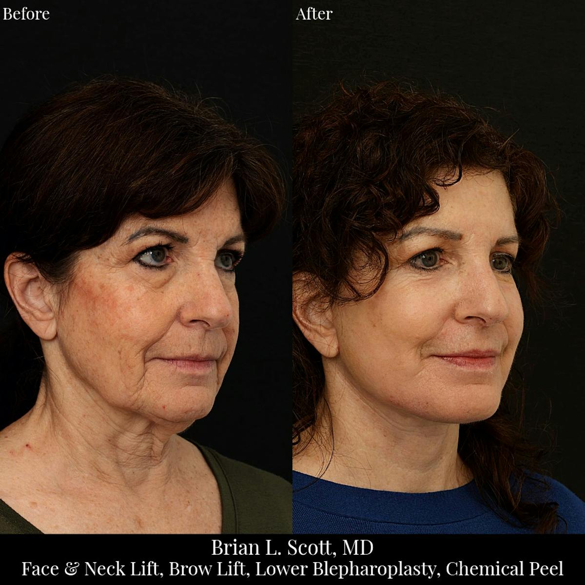 Facelift Before & After Gallery - Patient 234101 - Image 1