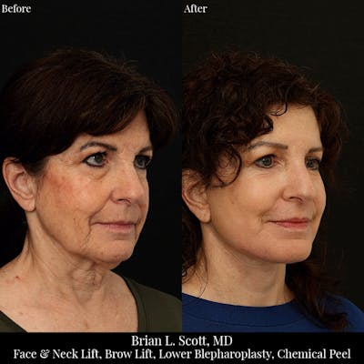 Neck Lift Before & After Gallery - Patient 221950 - Image 1