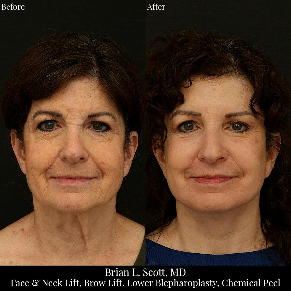 Facelift Before & After Gallery - Patient 234101 - Image 3