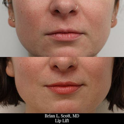 Lip Lift Before & After Gallery - Patient 386020 - Image 1